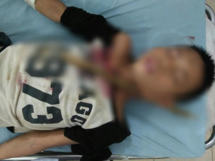 Trèo cây ngã, bé trai 12 tuổi ở Sơn La bị cành cây đâm xuyên cổ-1