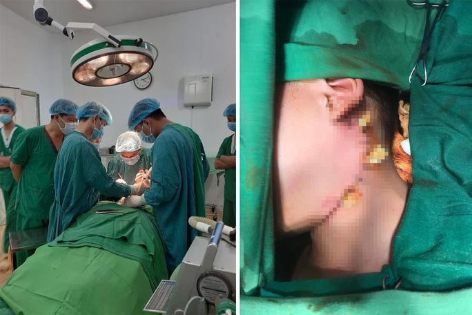 Trèo cây ngã, bé trai 12 tuổi ở Sơn La bị cành cây đâm xuyên cổ-2