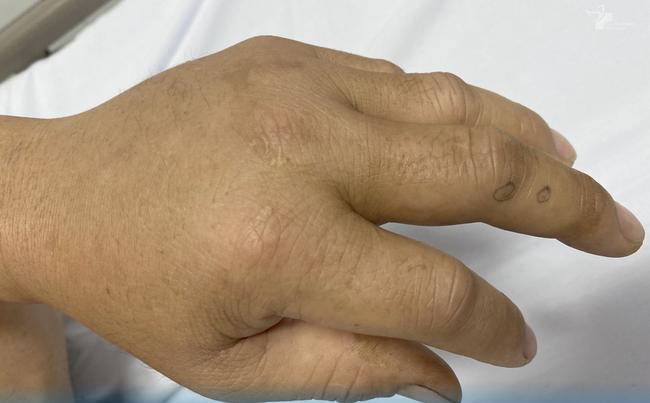 Ra vườn hái rau, người đàn ông bị rắn lục đuôi đỏ cực độc cắn suýt chết-2