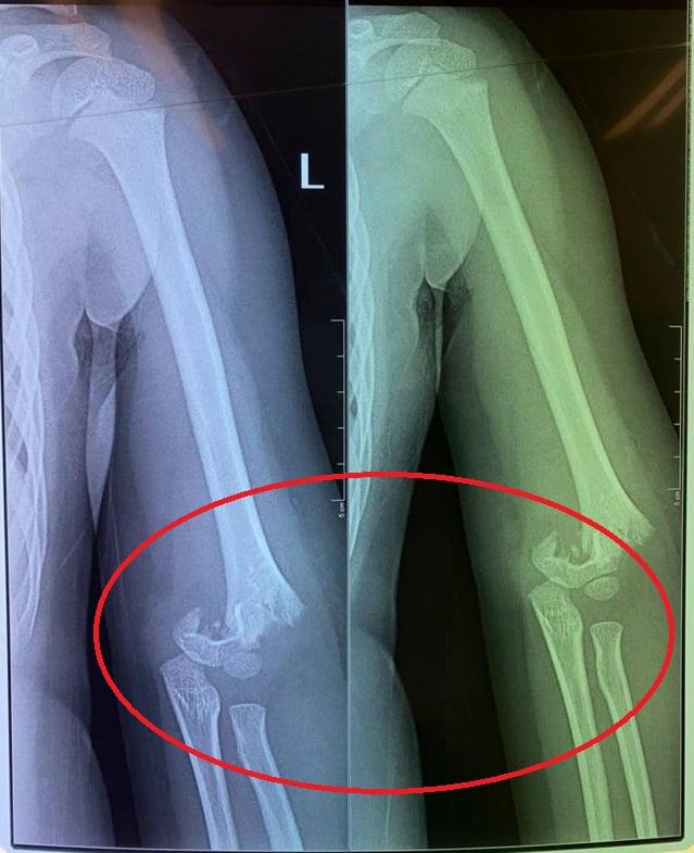 Bé 5 tuổi bị bạn đẩy ngã gẫy tay nhưng cô giáo không đưa đi cấp cứu ngay-1