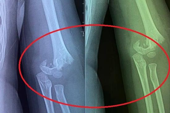 Bé 5 tuổi bị bạn đẩy ngã gẫy tay nhưng cô giáo không đưa đi cấp cứu ngay