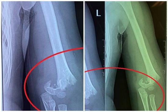 Bé gái 5 tuổi đi mẫu giáo bị bạn đẩy ngã gãy tay nhưng cô giáo không đưa đi cấp cứu ngay, người mẹ chia sẻ: Nhà trường bặt vô âm tín!