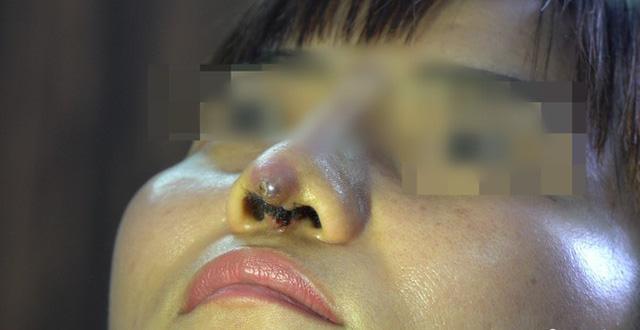 Phẫu thuật chui, người phụ nữ bị đứt lìa trụ mũi, thê thảm sau 12 ngày dao kéo-1