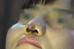 Phẫu thuật 'chui', người phụ nữ bị đứt lìa trụ mũi, thê thảm sau 12 ngày 'dao kéo'