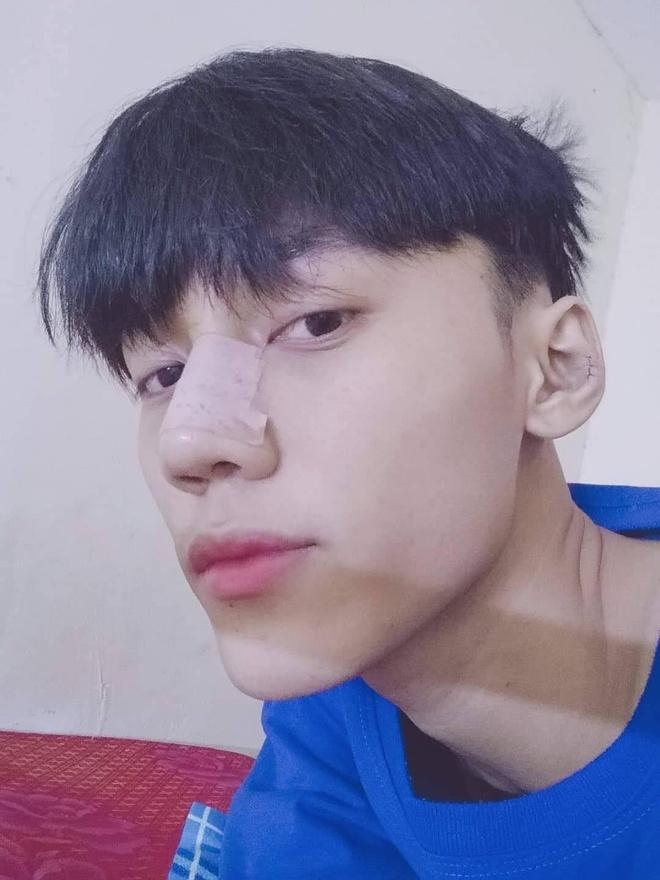 Chàng trai 19 tuổi chi 70 triệu đồng phẫu thuật thẩm mỹ-2