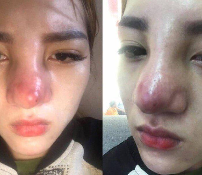 Pha phẫu thuật nâng mũi như phù thủy gây xôn xao mạng xã hội-9