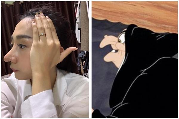 Tiêm filler nâng mũi, nữ nhân viên ngân hàng ở Thái Nguyên suýt mù mắt-8