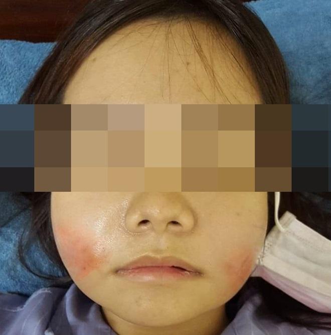 Tiêm filler nâng mũi, nữ nhân viên ngân hàng ở Thái Nguyên suýt mù mắt-3