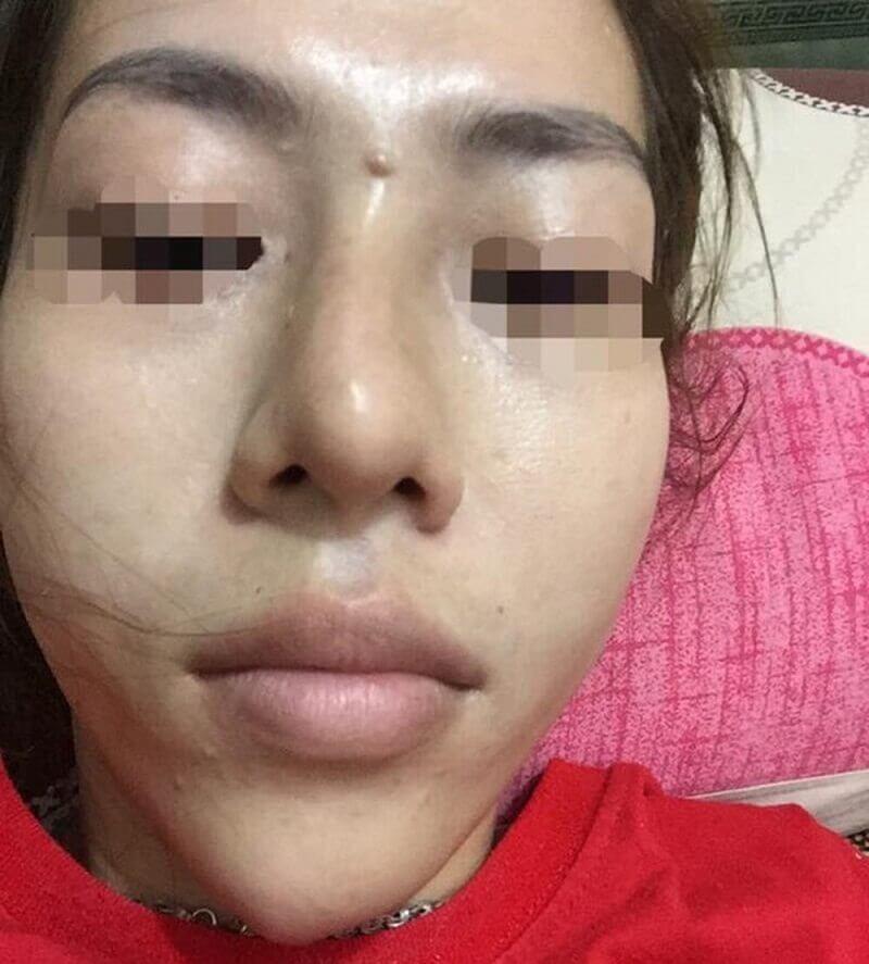 Tiêm filler nâng mũi, nữ nhân viên ngân hàng ở Thái Nguyên suýt mù mắt-5