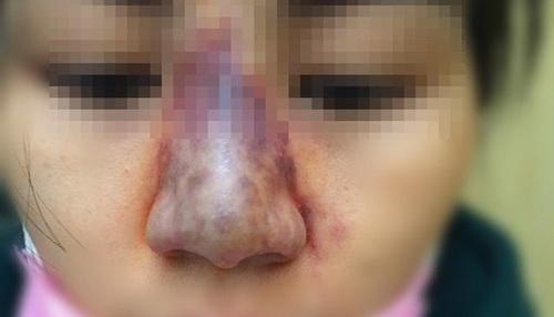 Tiêm filler nâng mũi, nữ nhân viên ngân hàng ở Thái Nguyên suýt mù mắt-6
