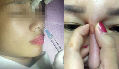 Tiêm filler nâng mũi, nữ nhân viên ngân hàng ở Thái Nguyên suýt mù mắt-7