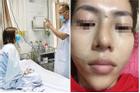 Tiêm filler nâng mũi, nữ nhân viên ngân hàng ở Thái Nguyên suýt mù mắt