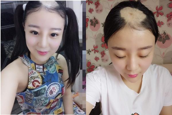 Cô gái bị hói một mảng đầu vì ăn ngô bằng máy khoan 4 năm trước giờ thế nào?-1