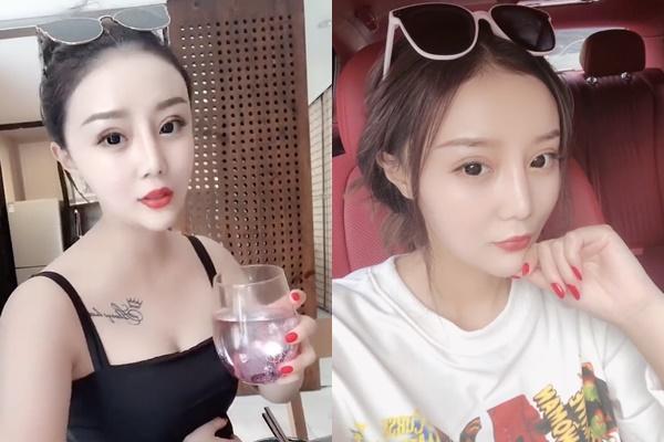 Cô gái bị hói một mảng đầu vì ăn ngô bằng máy khoan 4 năm trước giờ thế nào?-5