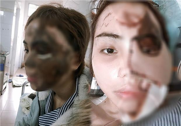 Cô gái bị chồng sắp cưới tạt axit lần đầu lộ diện cả khuôn mặt, tiết lộ 16 lần phẫu thuật đau đớn-1