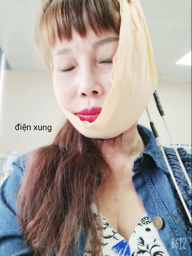 Cô dâu Cao Bằng nhập viện trị méo miệng vì di chứng sau phẫu thuật căng da mặt-3