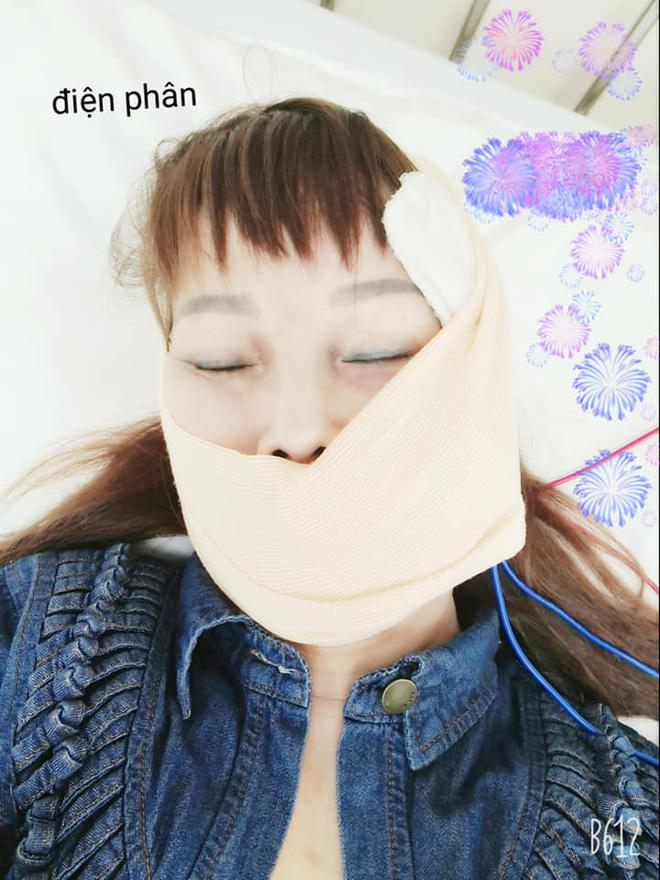 Cô dâu Cao Bằng nhập viện trị méo miệng vì di chứng sau phẫu thuật căng da mặt-4