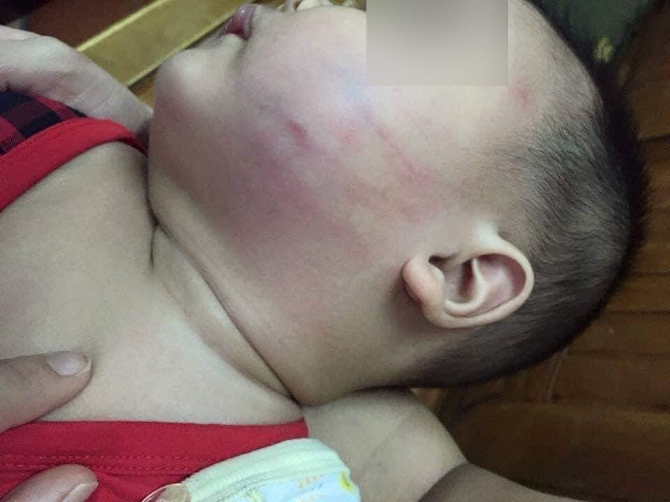 Bé 8 tháng ở Đà Nẵng đi nhà trẻ, mẹ tá hỏa thấy má con bầm tím đáng sợ-1