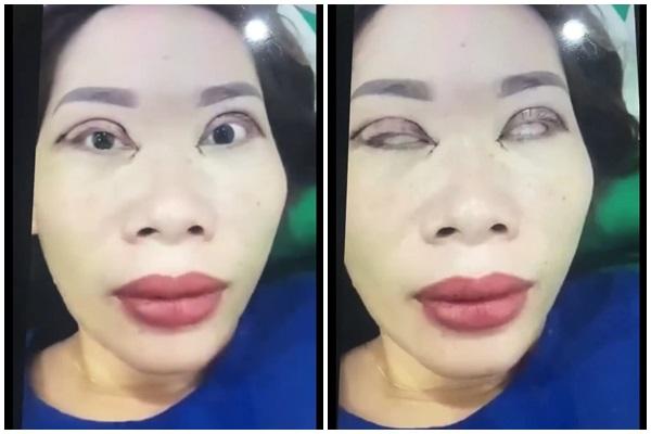 Thảm họa cắt mí: Cô gái 5 lần phẫu thuật vì mắt con đậu con bay-11