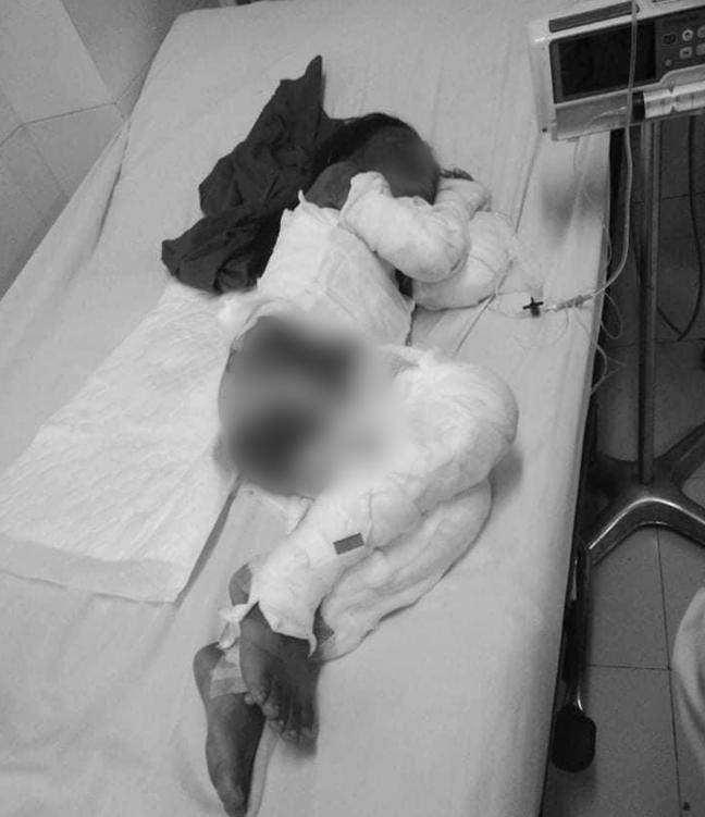 Dự trữ xăng không may bị ụp vào bếp lửa, bé gái lớp 2 hóa ngọn đuốc sống-1