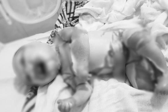 Thêm một bé sơ sinh bị bệnh vảy cá hiếm gặp, toàn thân da khô cứng nở như vôi