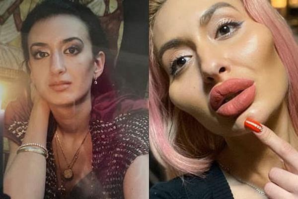 Thiếu nữ 21 tuổi mù mắt trái vì nhờ bạn thân tiêm filler nâng mũi đón Tết-4