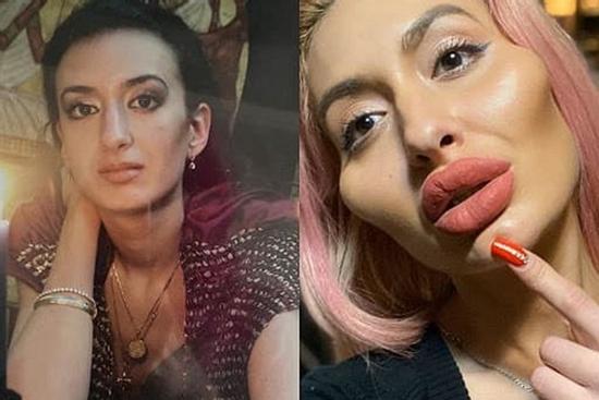 4 năm tiêm filler nhưng 'người mẫu có gò má bự nhất thế giới' vẫn chưa thỏa mãn: 'Tôi thấy còn nhỏ lắm'