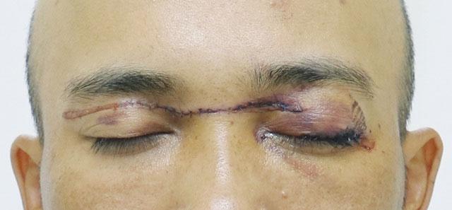 Người đàn ông suýt mù mắt khi va phải dây diều thả trên đường ở Quảng Ninh-1