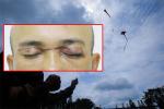 Người đàn ông suýt mù mắt khi va phải dây diều thả trên đường ở Quảng Ninh