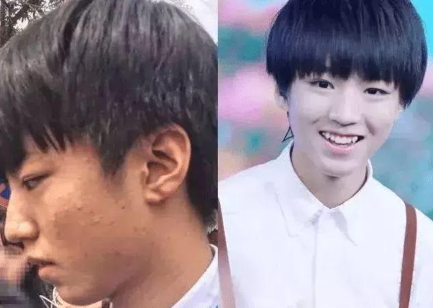 Loạt mỹ nam Hoa ngữ bị bóc làn da lỗ chỗ, đầy mụn-1