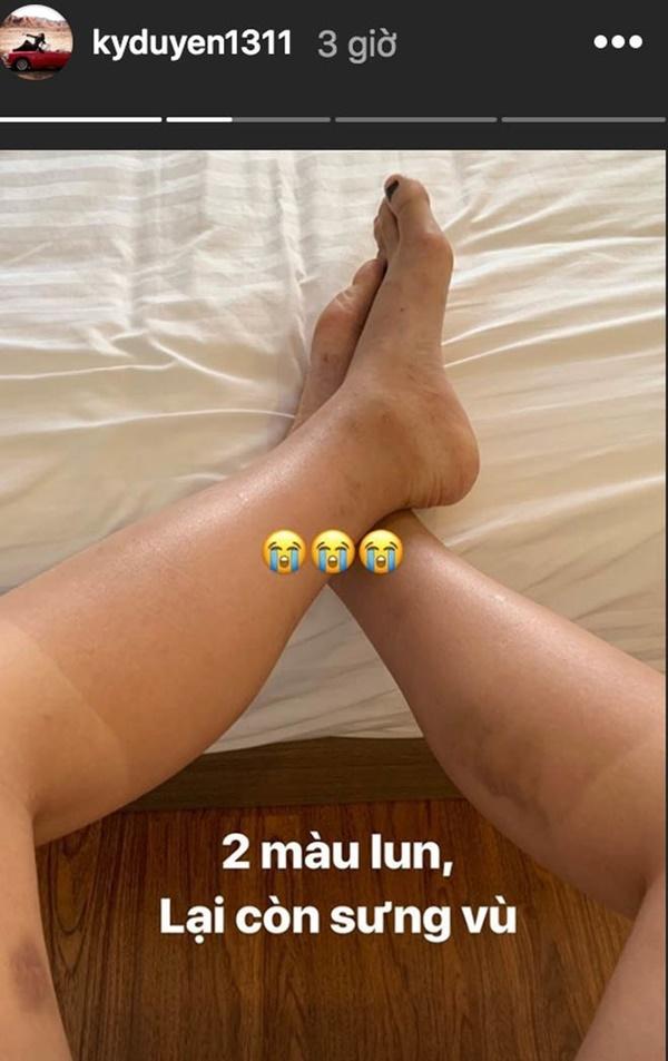 Sở hữu đôi chân ngọc ngà, Hari Won và Thiều Bảo Trâm lộ vết thương chi chít-5