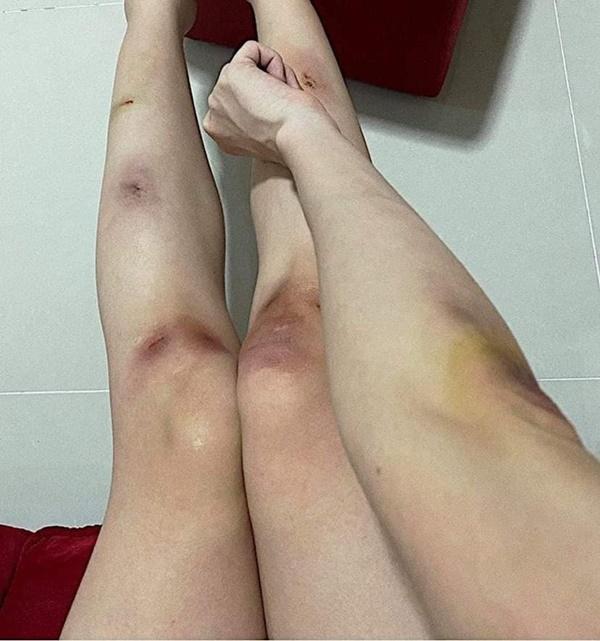 Sở hữu đôi chân ngọc ngà, Hari Won và Thiều Bảo Trâm lộ vết thương chi chít-10