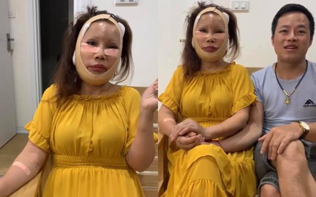 Bất ngờ gương mặt trẻ đẹp của cô dâu Cao Bằng sau gần 4 tháng dao kéo-1