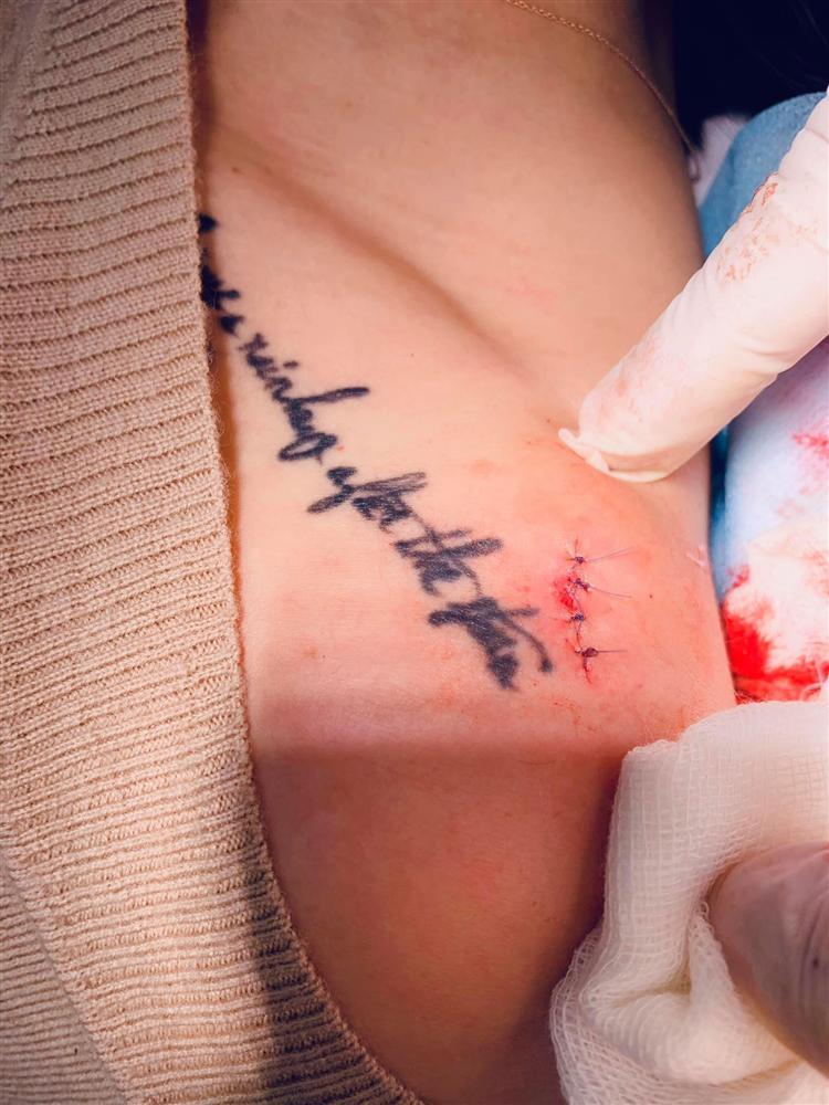 MC Hoàng Linh phẫu thuật cắt u mỡ, cạnh hình xăm bí ẩn ở vai-1