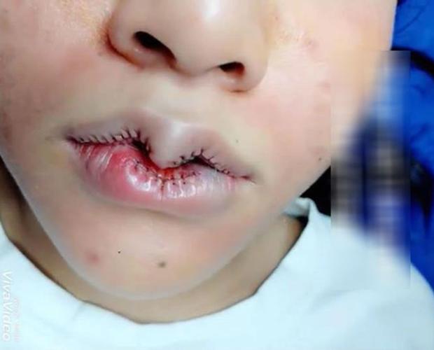 Những pha thẩm mỹ môi trái tim nhìn mà hốt, có nàng còn không khép được môi-4