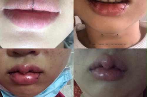 Những pha thẩm mỹ môi trái tim nhìn mà hốt, có nàng còn không khép được môi-6