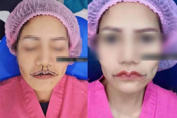 Hết hồn đôi môi đại bàng tung cánh của cô gái trẻ sau phẫu thuật-3