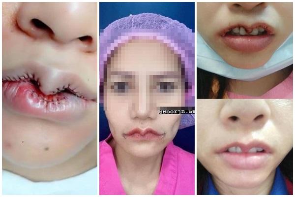 RÙNG MÌNH: Mặt rộp như bánh đa sau khi căng da bằng phương pháp Hifu-8