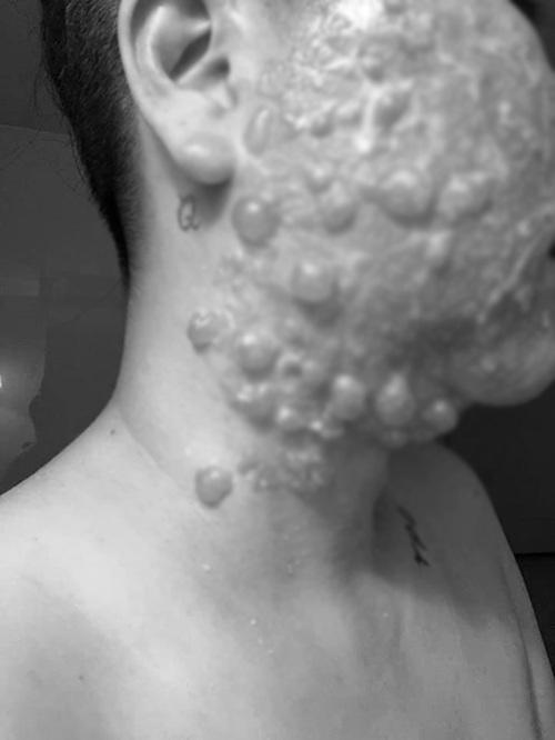 RÙNG MÌNH: Mặt rộp như bánh đa sau khi căng da bằng phương pháp Hifu-2