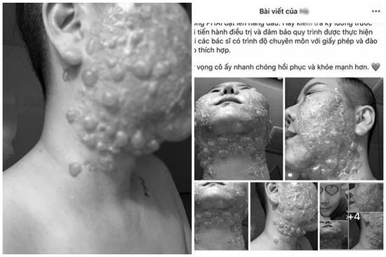 RÙNG MÌNH: Mặt rộp như bánh đa sau khi căng da bằng phương pháp Hifu