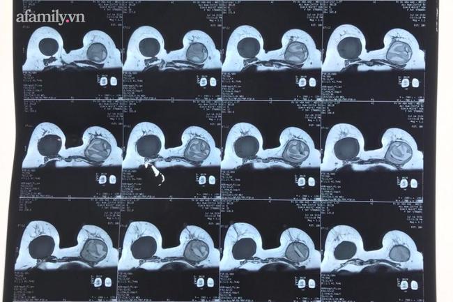 TP.HCM: Người phụ nữ 34 tuổi bị vỡ túi ngực vì làm đẹp tại cơ sở kém chất lượng-1