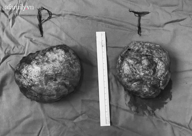 TP.HCM: Người phụ nữ 34 tuổi bị vỡ túi ngực vì làm đẹp tại cơ sở kém chất lượng-2