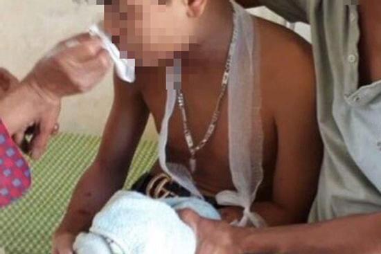 Máy tính xách tay bất ngờ phát nổ khi học bài, 3 học sinh nát tay, bị thương vùng mặt