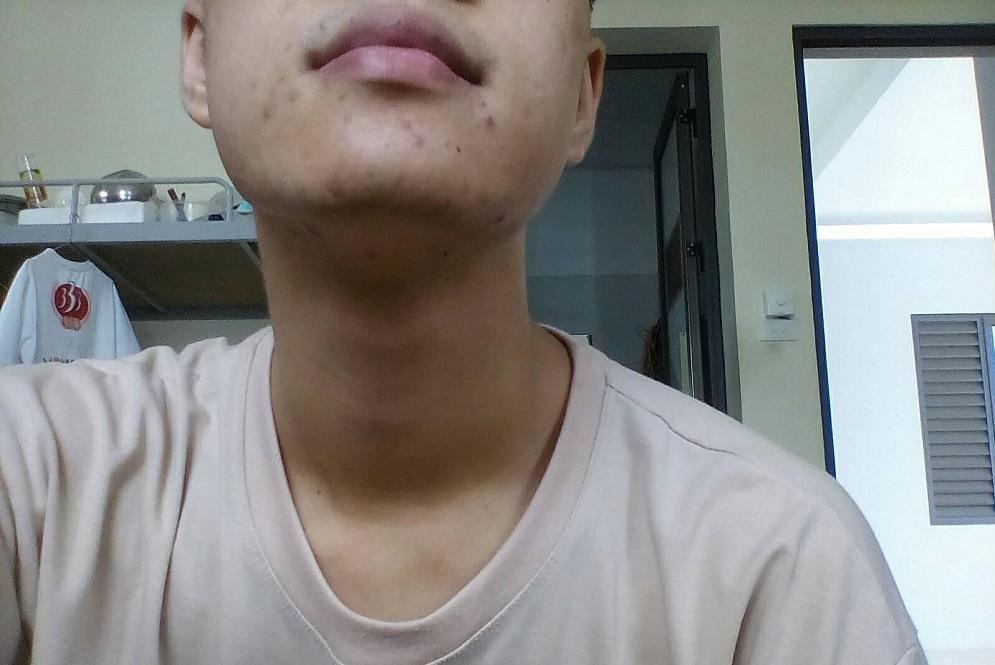 Sản phẩm ngừa mụn với chiết xuất thảo dược chinh phục giới trẻ-1