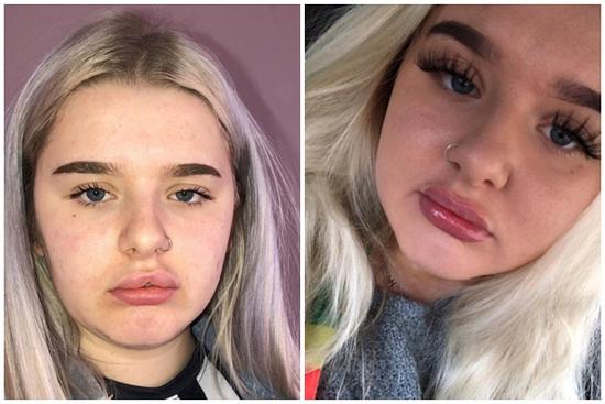 Nữ sinh đau đớn khi bơm môi giống Kylie Jenner