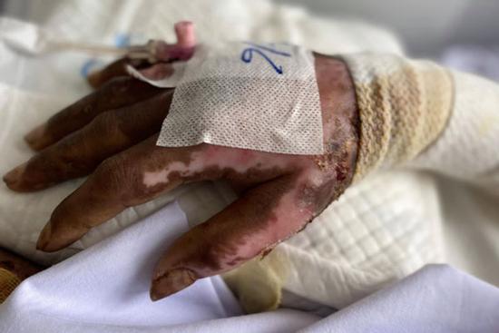 Đau lòng: Cha đón con đi học về rồi đóng cửa nhà châm lửa đốt, 2 cháu bé bị bỏng rất nặng