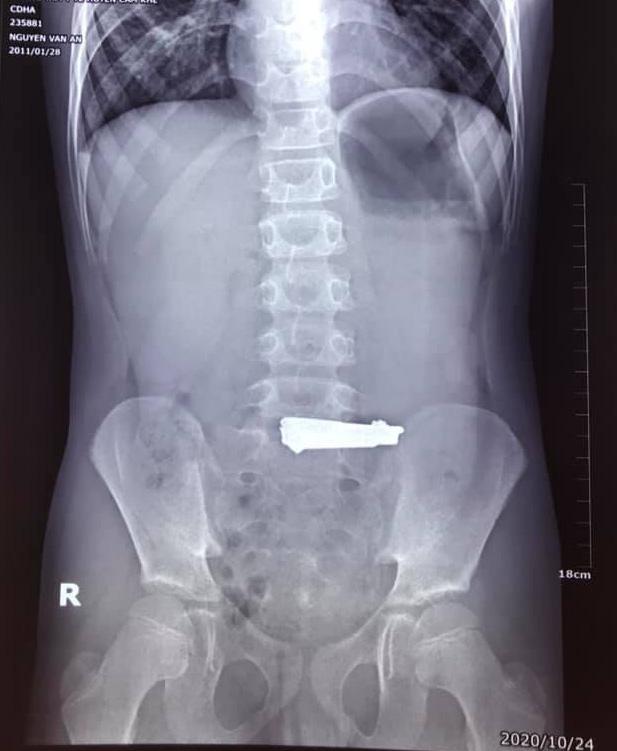 Bé gái 9 tuổi ở Phú Thọ nuốt nguyên cái bấm móng tay vì học theo video trên Youtube-1