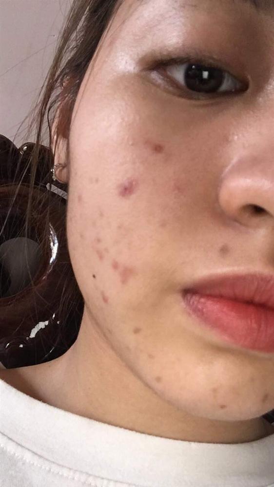 Hot girl trứng rán Thanh Tâm lấy hết can đảm khoe ảnh mặt mộc chi chít mụn-4