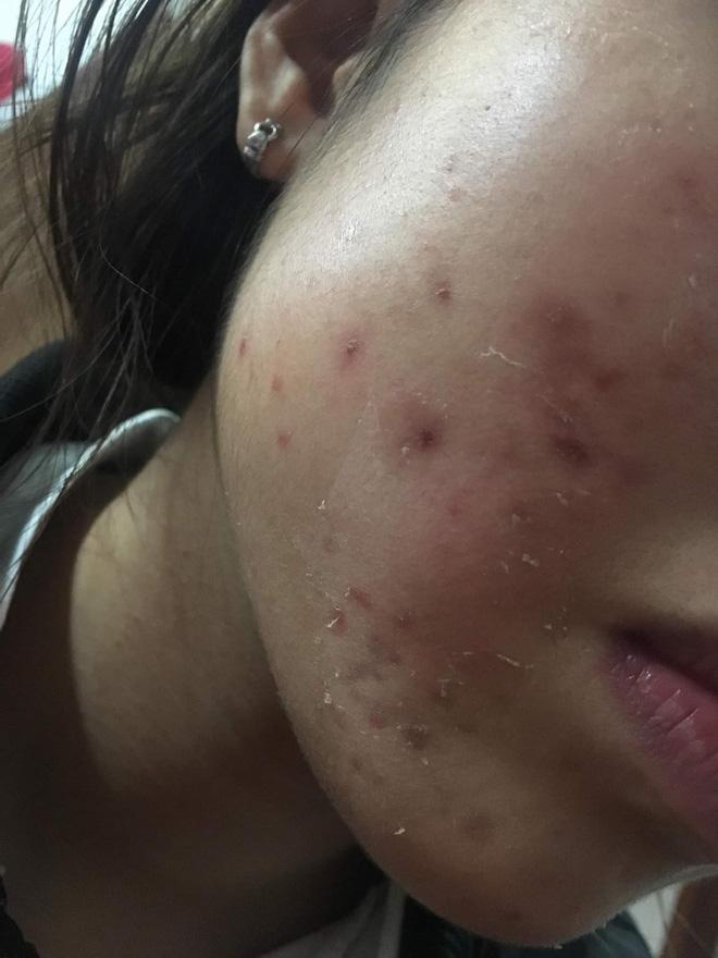 Hot girl trứng rán Thanh Tâm lấy hết can đảm khoe ảnh mặt mộc chi chít mụn-5