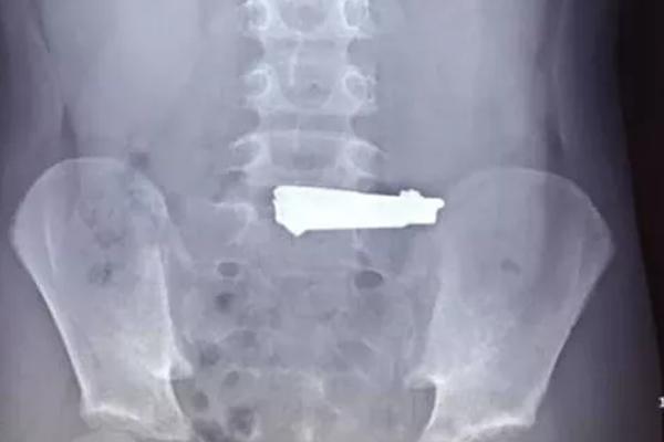 CẢNH BÁO: Nhiều học sinh dùng dao lam tự rạch cơ thể, coi đó là thú vui xả stress-6